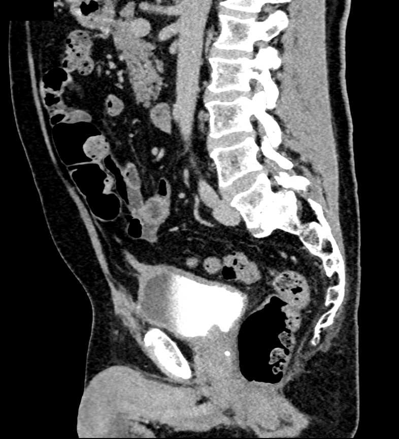 Urachal Remnant with Minimal Thickening - CTisus CT Scan