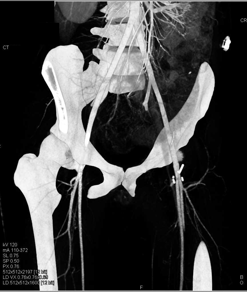 Acute Pyelonephritis Left Kidney - CTisus CT Scan