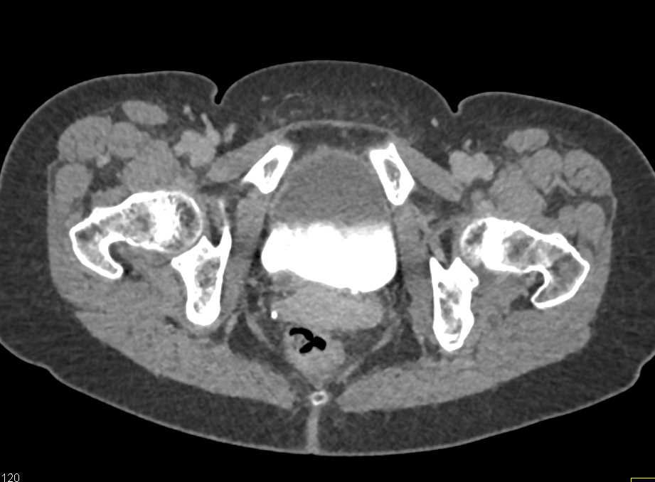 Bladder Cancer at the Right Ureterovesical Junction (UVJ) with Tumor Present - CTisus CT Scan