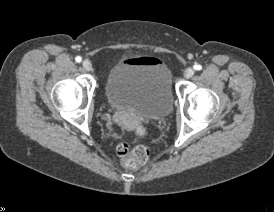 Bladder Cancer at the Right Ureterovesical Junction (UVJ) with Tumor Present - CTisus CT Scan