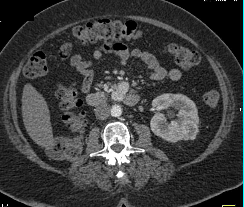 Recurrent Renal Cell Carcinoma with Contralateral Metastases, Pancreatic Metastases and Vascular Adenopathy - CTisus CT Scan