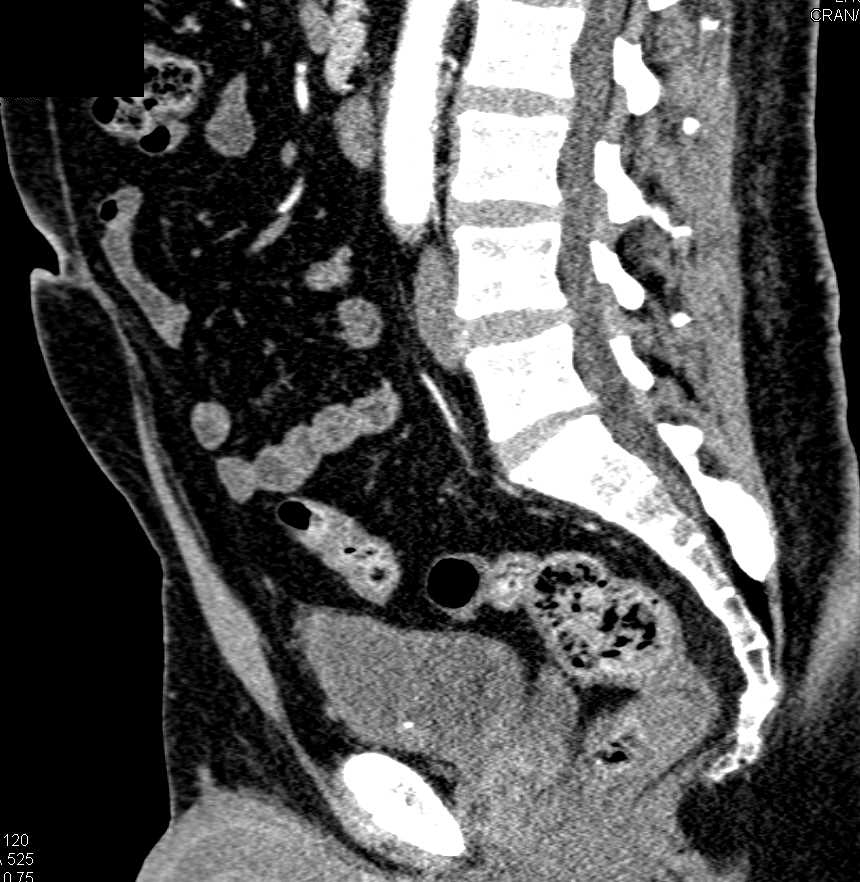 Incidental Bladder Cancer - CTisus CT Scan