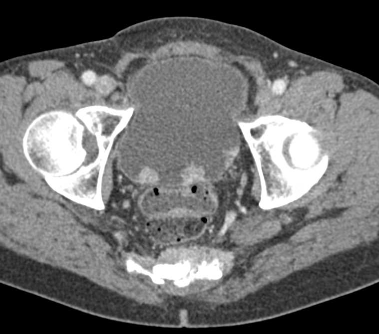 Multifocal Bladder Cancers - CTisus CT Scan