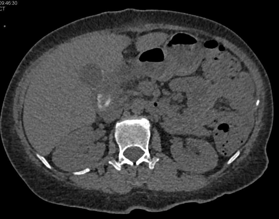 CT Cystogram with Bladder Leak - CTisus CT Scan