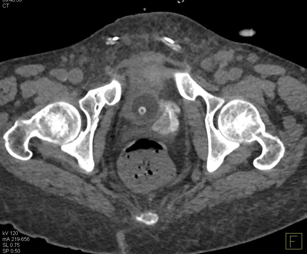 CT Cystogram with Bladder Leak Best Seen on Delayed Imaging - CTisus CT Scan