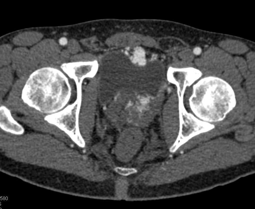 Vascular Lesion Near Bladder - CTisus CT Scan