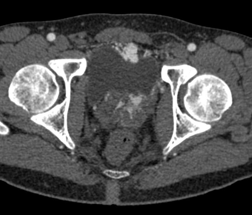 Vascular Lesion Near Bladder - CTisus CT Scan