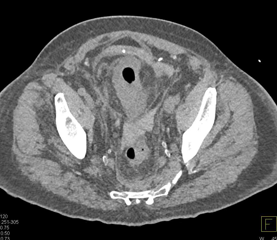 Perforated Bladder on CT Cystogram - CTisus CT Scan