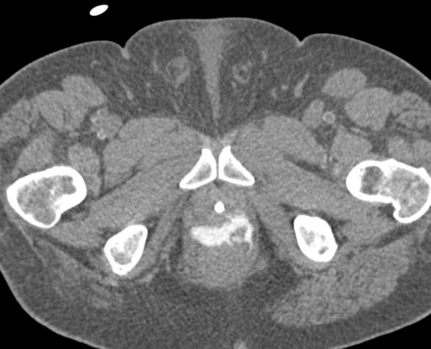 Diverticulitis with Fistulae to Dome of Bladder for Enterovesical Fistulae - CTisus CT Scan