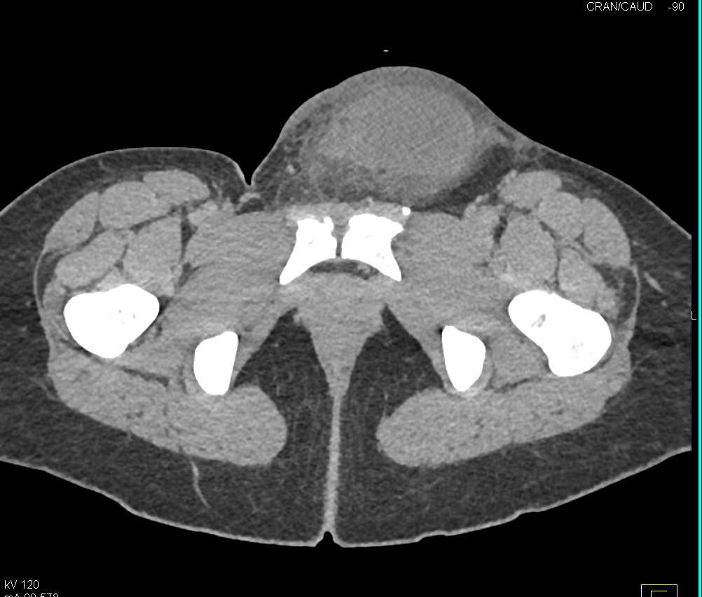 Scrotal Hematoma Following Trauma - CTisus CT Scan