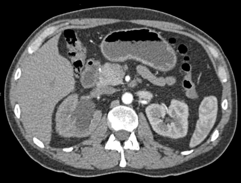 Carcinoma of Distal Right Ureter Obstructing the Right Kidney - CTisus CT Scan