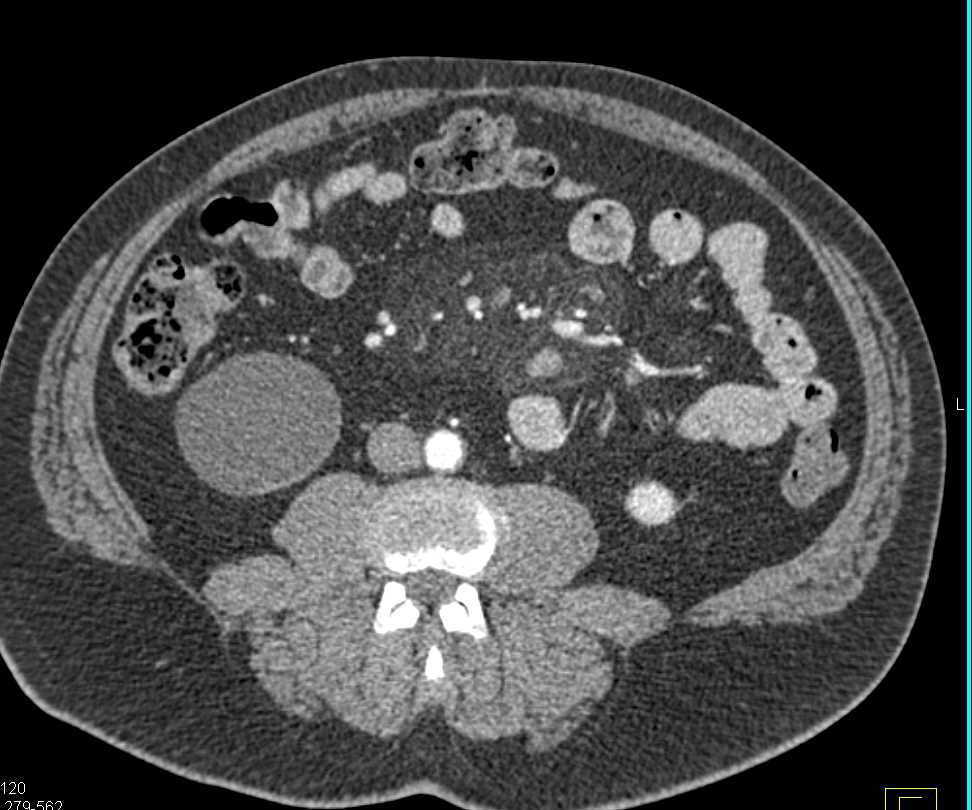 Incidental Bladder Cancer (Right Wall) in Patient with Misty Mesentery - CTisus CT Scan