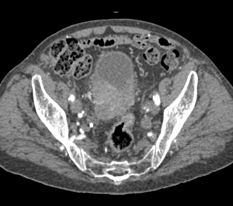 Bulky Bladder Cancer - CTisus CT Scan