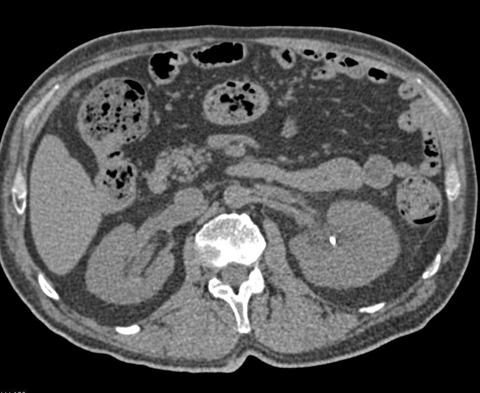 Obstructing Stone in Proximal Left Ureter - CTisus CT Scan