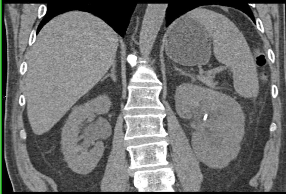 Obstructing Stone in Proximal Left Ureter - CTisus CT Scan