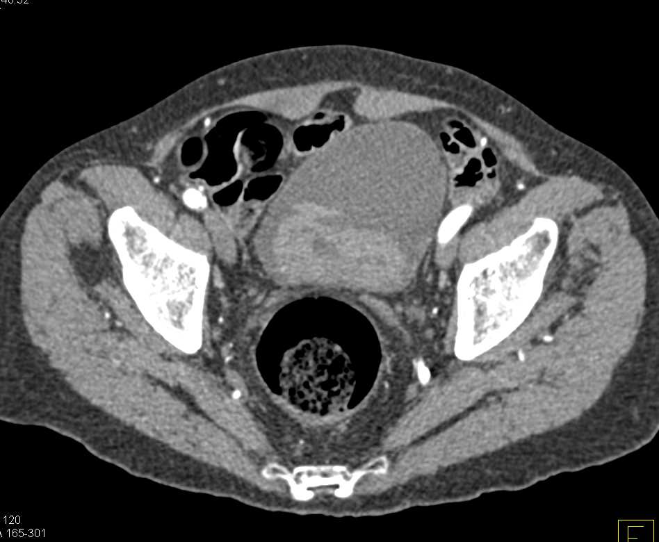 Active Bladder Hemorrhage - CTisus CT Scan