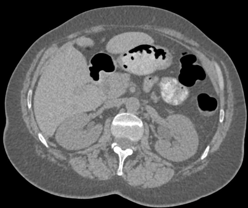 Bladder Cancer Seen Best on Arterial Phase Imaging - CTisus CT Scan