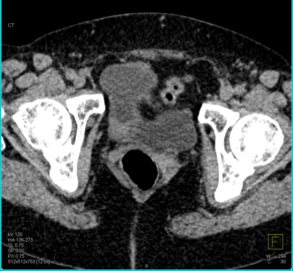 Incidental Bladder Carcinoma in Right Wall of the Bladder - CTisus CT Scan