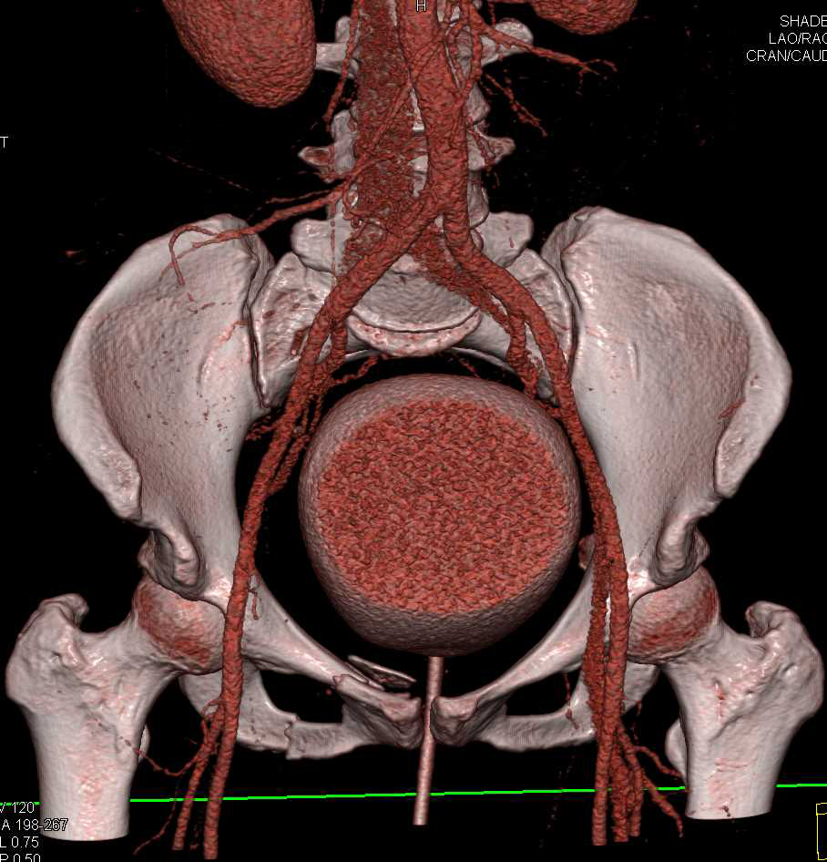 Sacral and Acetabular Fractures with Bladder Trauma and Pelvic Bleed - CTisus CT Scan