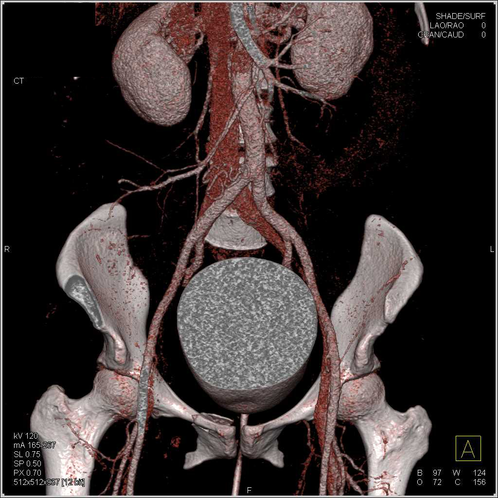 Sacral and Acetabular Fractures with Bladder Trauma and Pelvic Bleed ...