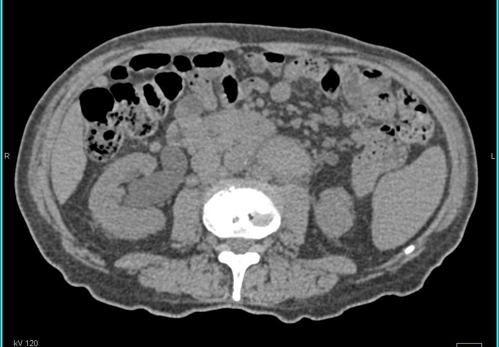 Bulky Bladder Cancer with Extensive Adenopathy - CTisus CT Scan