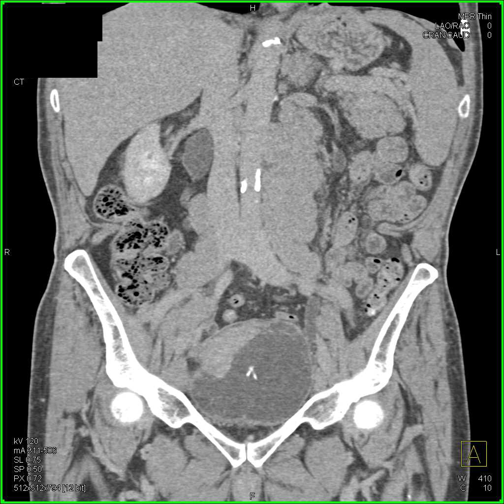 Bulky Bladder Cancer with Extensive Adenopathy - CTisus CT Scan