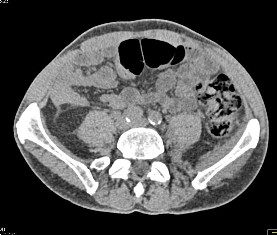 Infiltrating Carcinoma of the Left Wall of the Bladder - CTisus CT Scan