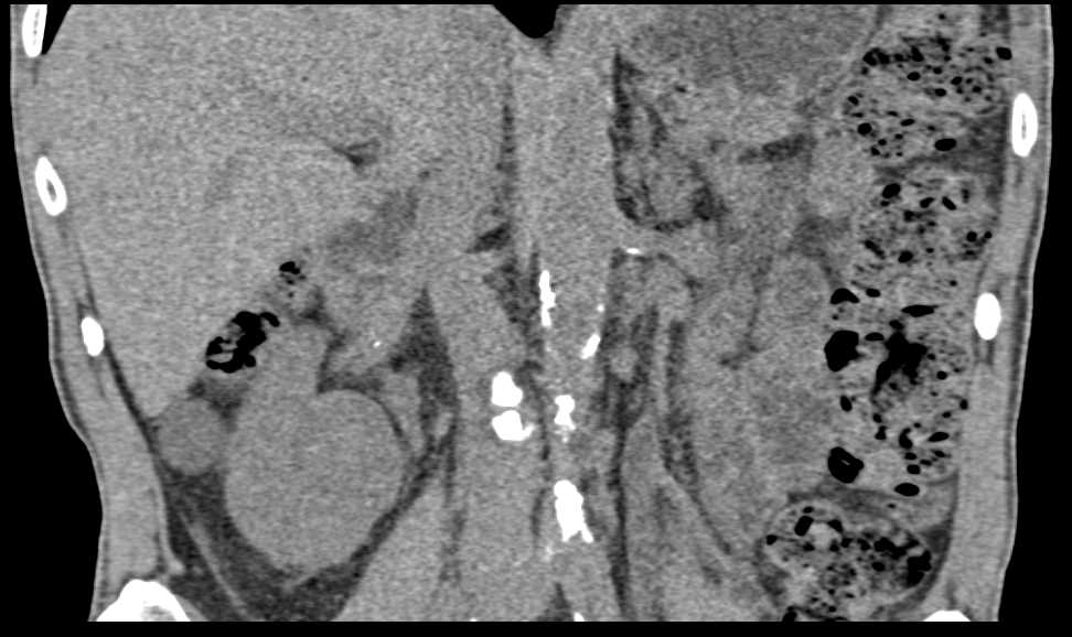 Bladder Cancer with Left Hydronephrosis - CTisus CT Scan