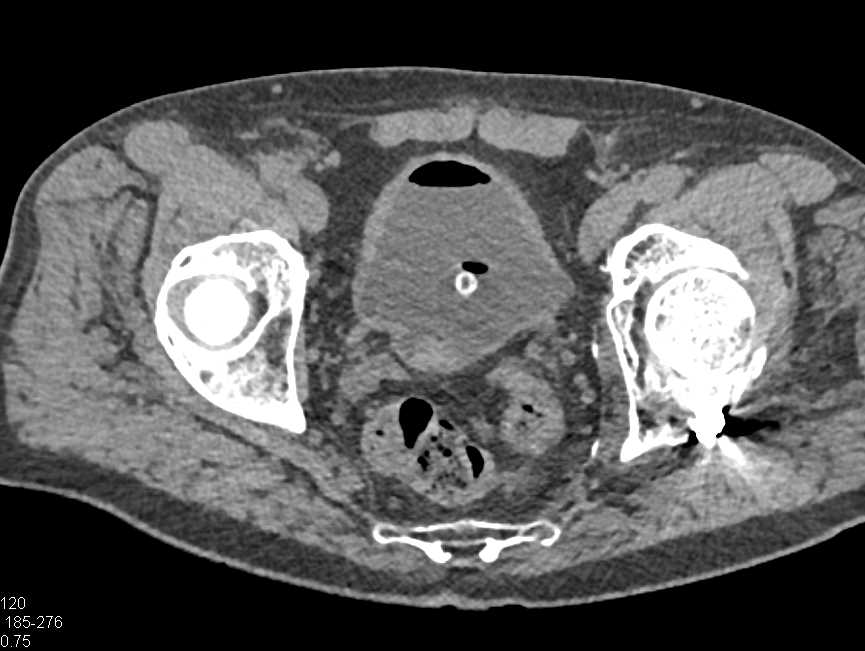 Bladder Cancer with Hemorrhage in Posterior Bladder - CTisus CT Scan