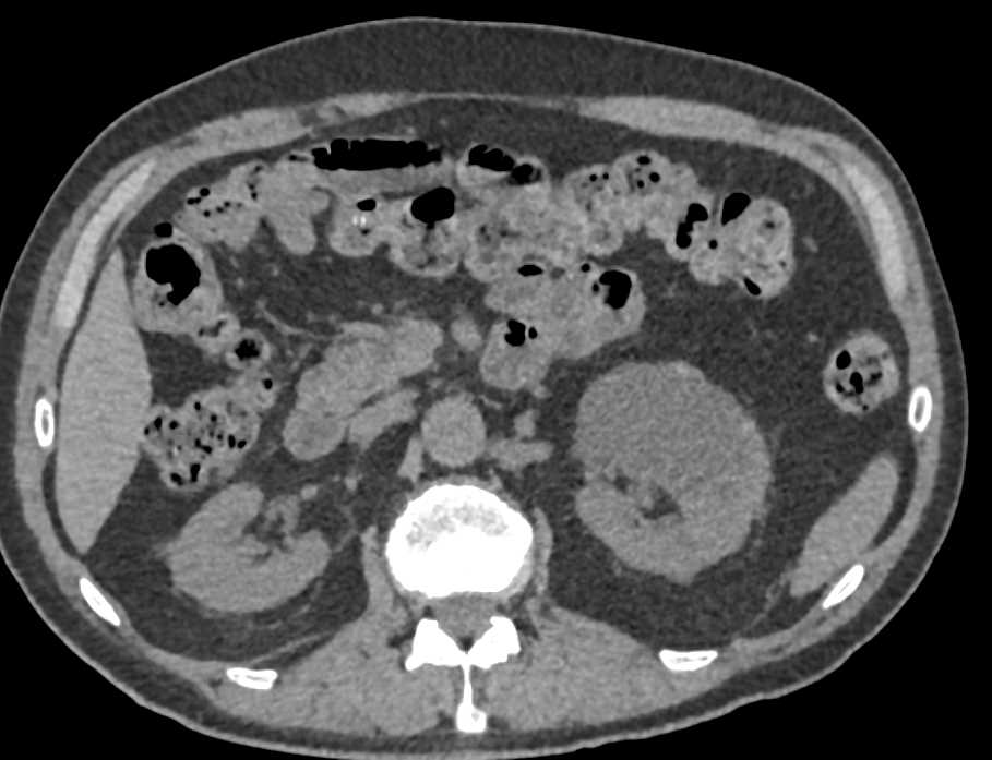 Minimal Thickening Ureter Without a Discrete Mass - CTisus CT Scan