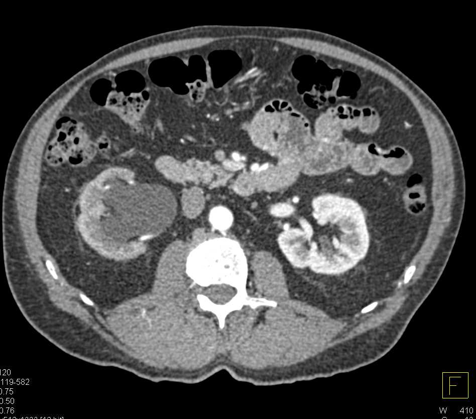 Infiltrating Bladder Cancer Causes Right Hydronephrosis - CTisus CT Scan