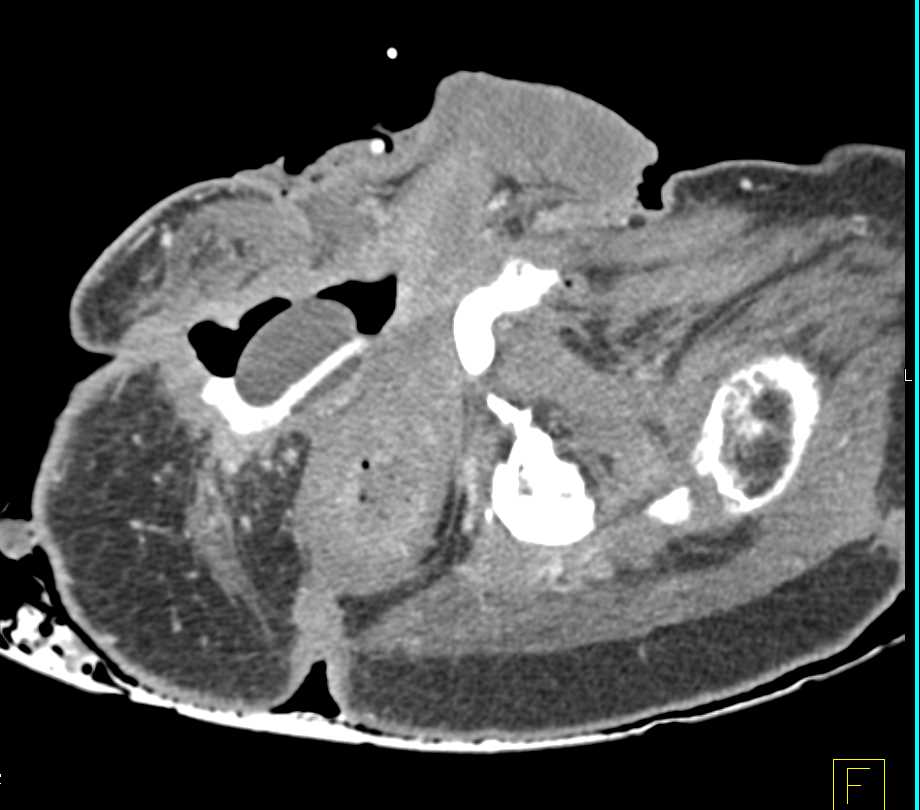 Foley Catheter Herniates Through Defect in Patient with Large Decubitus Ulcers and Bone Erosions - CTisus CT Scan