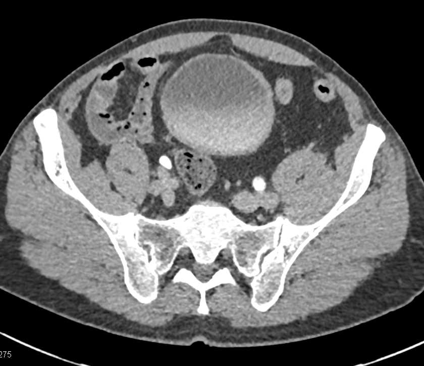 Carcinoma at the Ureterovesical Junction (UVJ) with Tumor Originating in the Distal Ureter - CTisus CT Scan