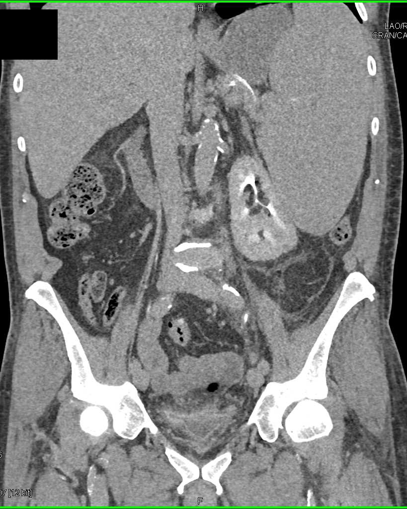 Infiltrating Bladder Cancer - CTisus CT Scan