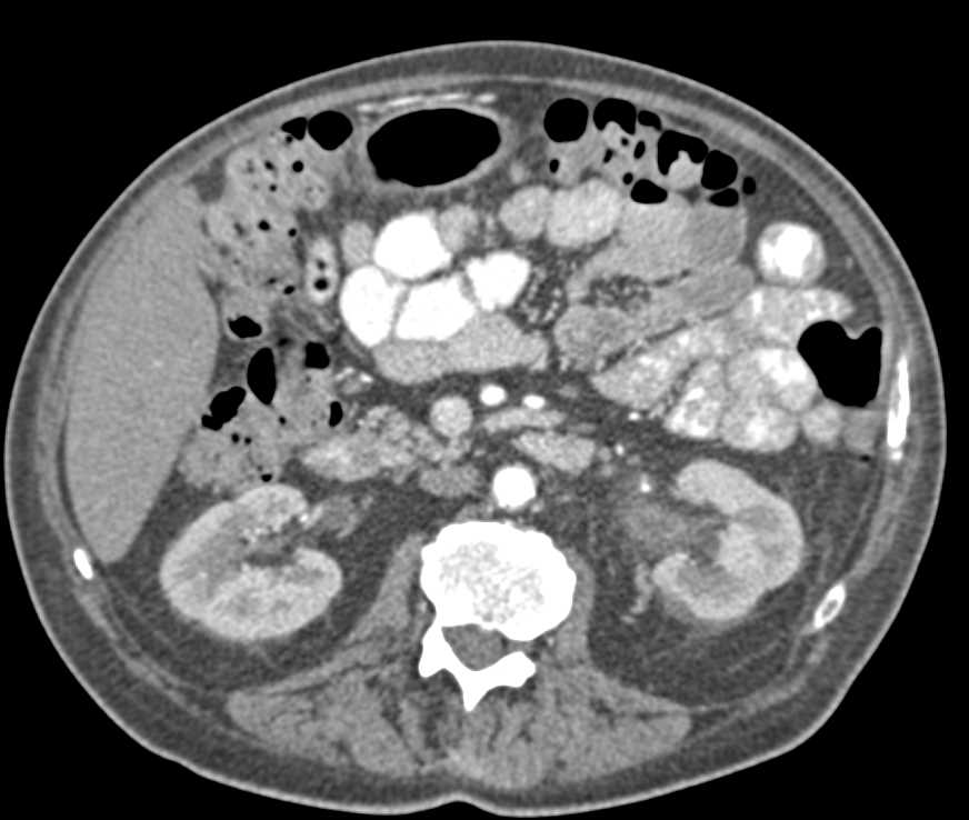 Multifocal Transitional Cell Carcinoma Involving the Bladder and Left Kidney - CTisus CT Scan