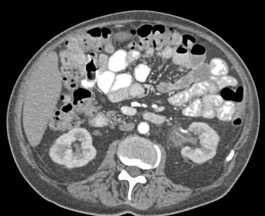 Multifocal Transitional Cell Carcinoma Involving the Bladder and Left Kidney - CTisus CT Scan