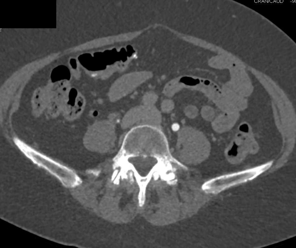 3D CT Defining Ileal Loop After Pelvic Surgery - CTisus CT Scan