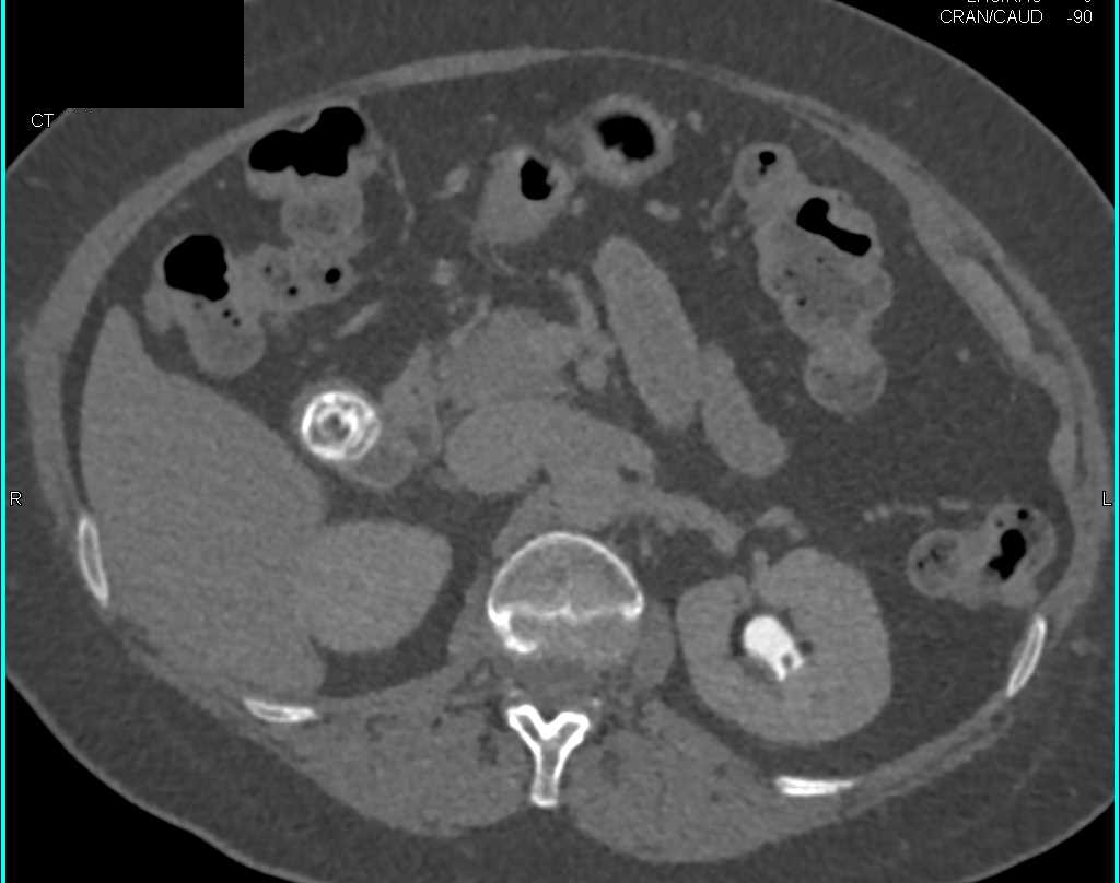 3D CT Defining Ileal Loop After Pelvic Surgery - CTisus CT Scan