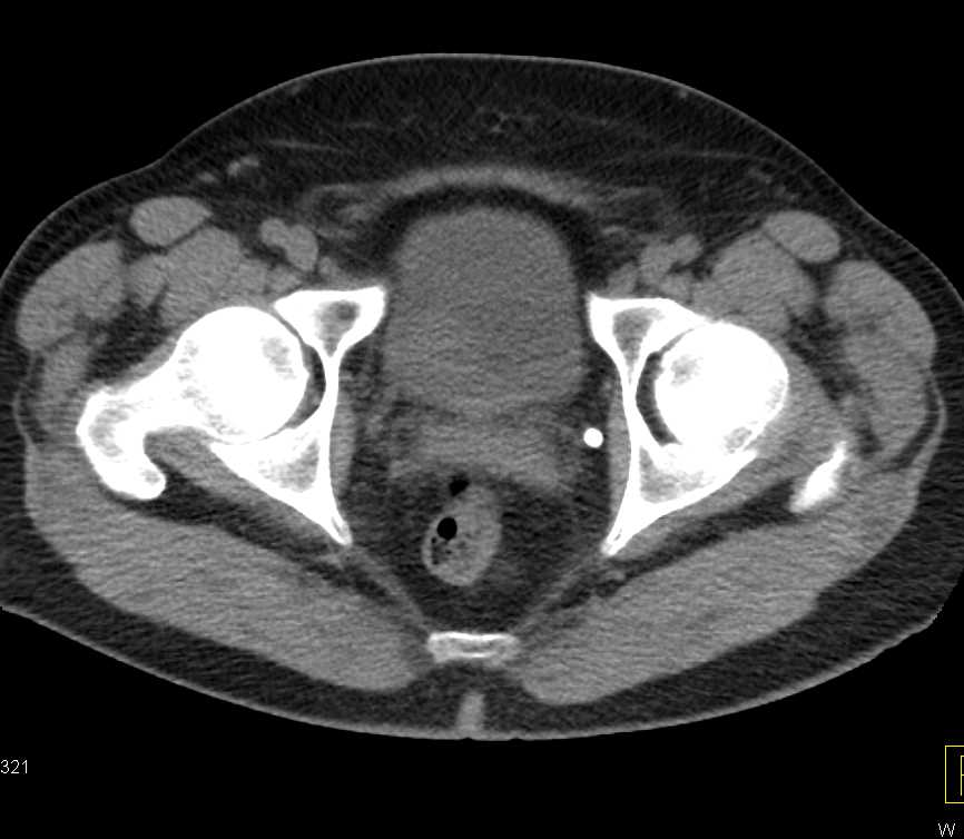 Pheochromocytoma in the Bladder - CTisus CT Scan