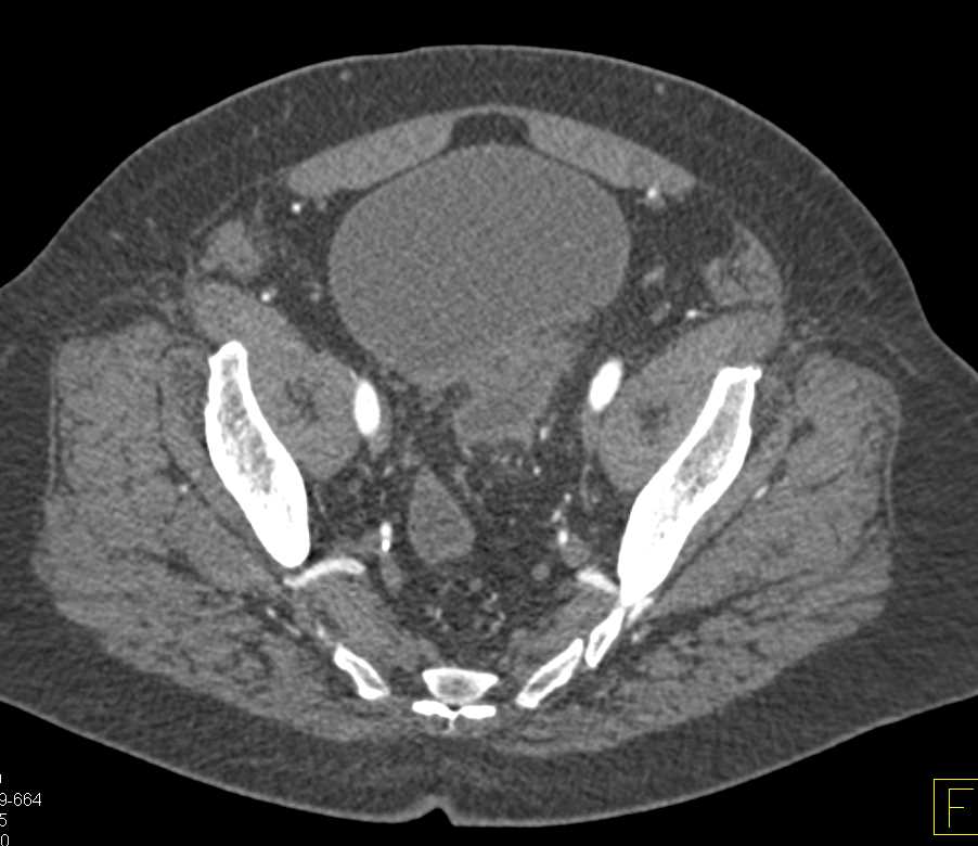 Carcinoma in Left Bladder Diverticulum - CTisus CT Scan