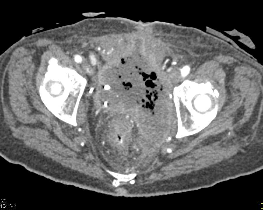 Necrotic Bladder Cancer in Pelvis - CTisus CT Scan