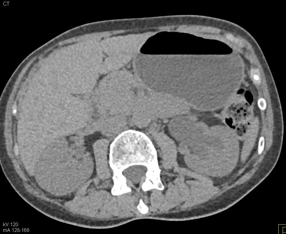 Left Hydronephrosis due to a Tumor of the Ureter - CTisus CT Scan