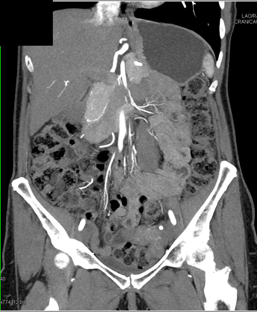 Left Hydronephrosis due to a Tumor of the Ureter - CTisus CT Scan