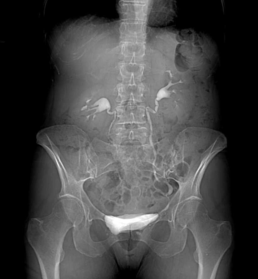 Transitional Cell Carcinoma Left Ureter - CTisus CT Scan