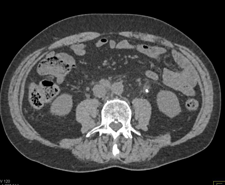 Transitional Cell Carcinoma Left Ureter - CTisus CT Scan