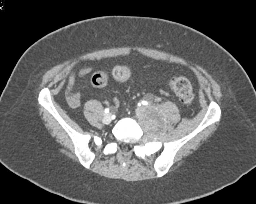 Necrotic Pelvic Nodes as well as Left Psoas Infiltration and Beyond - CTisus CT Scan