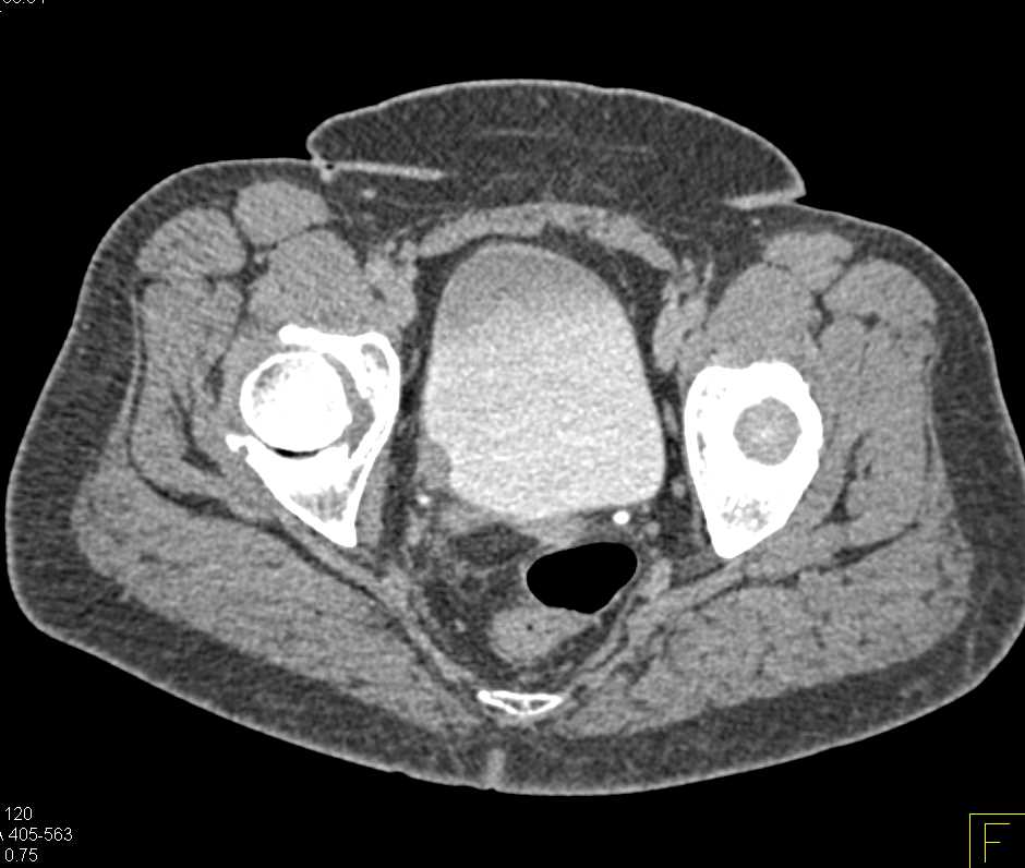 Bladder Cancer at the Right Ureterovesical Junction (UVJ ...