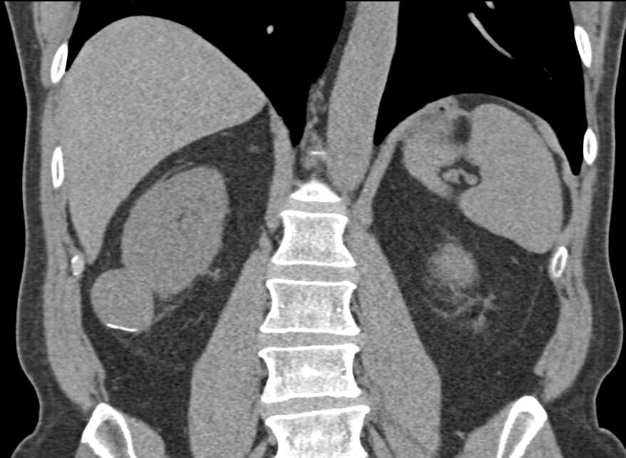 Carcinoma of the Bladder Posteriorly on the Right - CTisus CT Scan