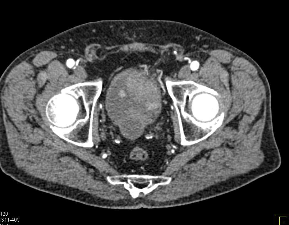 Bladder Cancer - CTisus CT Scan