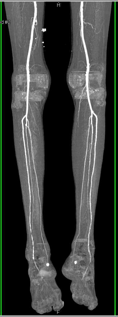 Subtle Bladder Cancer with Normal Runoff - CTisus CT Scan